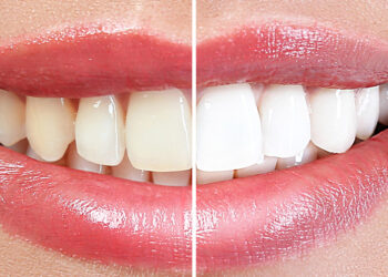Bleaching: Who is suitable and how does the treatment work?