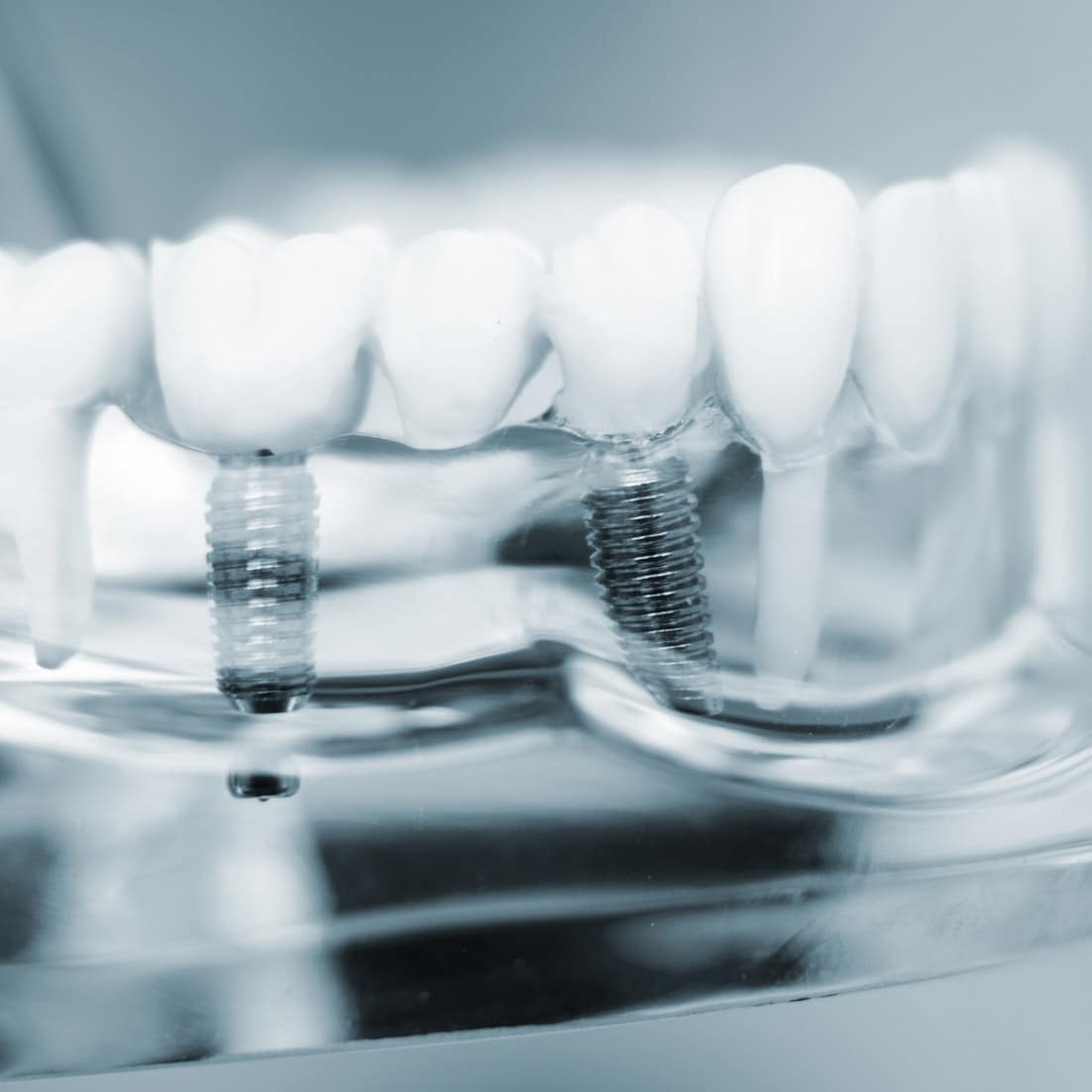 CEREC Zahnimplantate in Köln