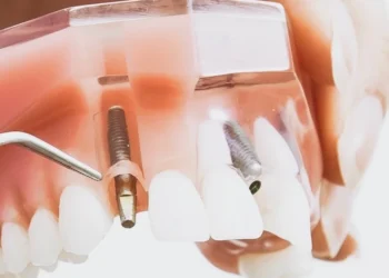 ZAHNIMPLANTAT HALTBARKEIT – WIE LANGE HALTEN SIE WIRKLICH?