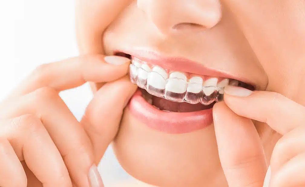 Invisalign Zahnbegradigung in Köln