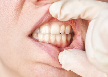 Parodontitis: Entstehung, Symptome und was dagegen hilft