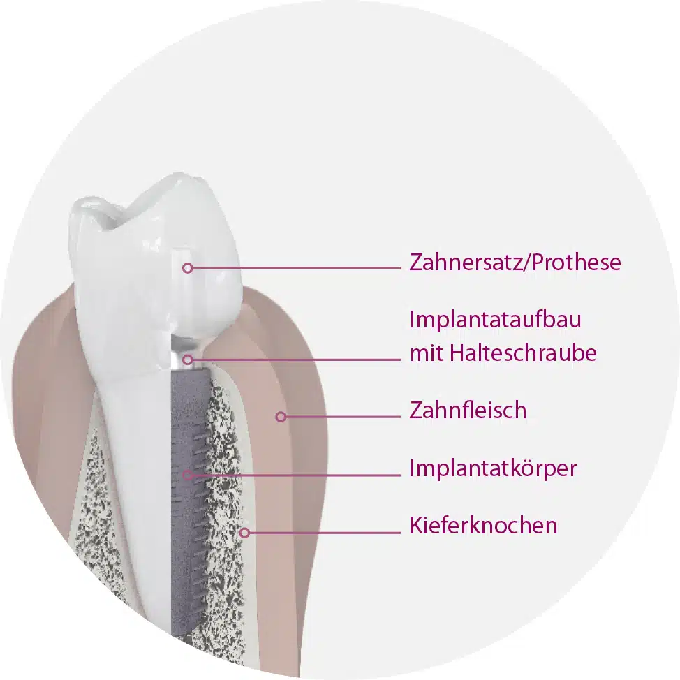 Aufbau Zahnimplantat - Zahnarzt Köln mundum